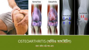 অষ্টিওআর্থাইটিস বা বয়স জনিত হাঁটু ক্ষয় রোগ