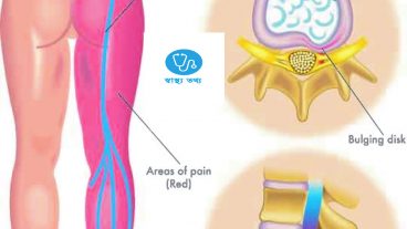 হঠাৎ কোমরে ব্যাথা? কারন ও প্রতিকার- একটি চিকিৎসা বিষয়ক টিউন