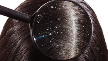 For dandruff here you can use this things