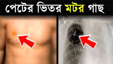 পেটের ভিতর জন্মালো গাছ VIDEO