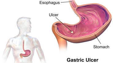 গ্যাস্টিক থেকে মিলবে চিরতরে মুক্তি