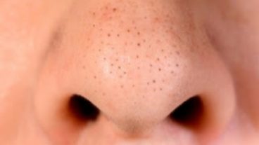 ব্ল্যাকহেডস দূর করার সহজ উপায় ঘরোয়া পদ্ধতিতে ব্ল্যাকহেডস দূর করুন