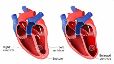 হার্ট ফেলিউর কী? হার্ট ফেলিউরের কারণ ও তার প্রতিকারের উপায় কী?