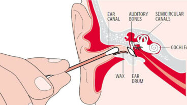 কটন বাড দিয়ে কান পরিষ্কার করে আপনি নিজেই নিজের বিপদ ডেকে আনছেন নাতো