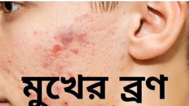 ব্রণ কিভাবে দূর করবেন?