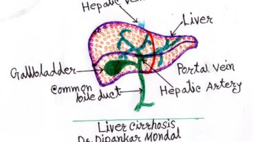 পিত্তথলির অপারেশন করার পর হজমের সমস্যায় করণীয়