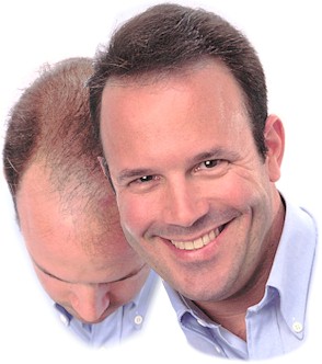 একটি মেগা টিপস, টাক মাথায় তাক লাগানো সমাধান