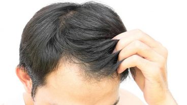 চুল পড়া প্রতিরোধে কার্যকর ১১ প্রাকৃতিক উপাদান