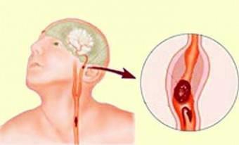 অতি সহজ উপায়ে স্ট্রোক সনাক্ত করার উপায়