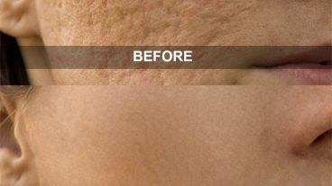 ফটোশপ শিখুন বাংলায় (পর্ব – ৬) কিভাবে ছবি থেকে মুখের দাগ দূর করবেন? (Remove Blemishes & Spots From Face)