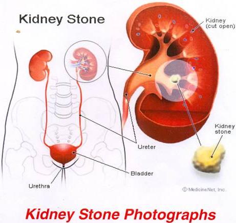 Kidney_stone_photographs