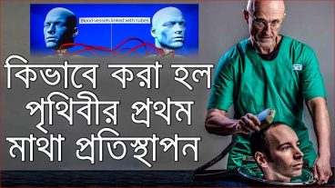 দেখুন কিভাবে করা হল পৃথিবীর প্রথম মানব মাথা প্রতিস্থাপন !!
